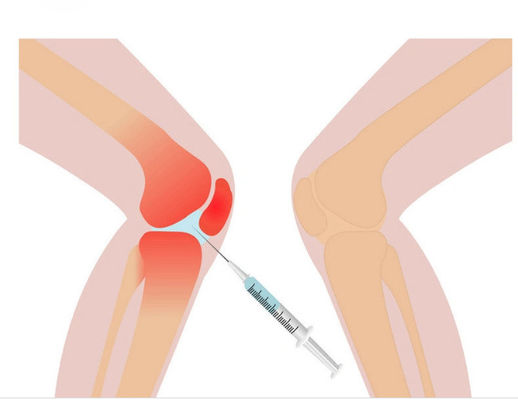 3ml Knee Pain Mesotherapy Solution Non Crosslinked Hyaluronic Acid