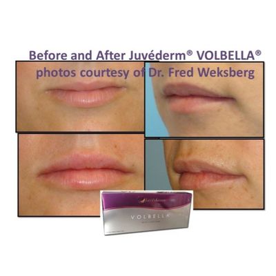 Hyaluronic Acid Juvederm Facial Filler Gel Smooth And Flawless Skin