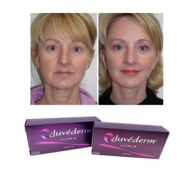 6-9 Months Duration Juvederm Dermal Filler Gel For Online And In Store Purchase