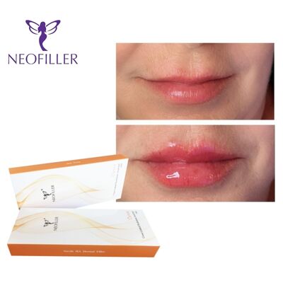 CE-Certified Cross-Linked Hyaluronic Acid Dermal Filler 24mg-ml Injectable Gel Lip Enhancement Facial Rejuvenation