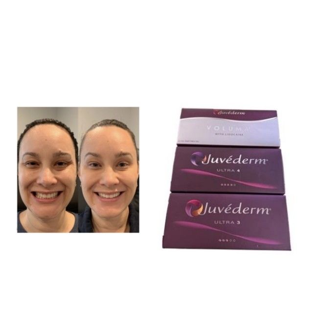Cross-linked HA Juvederm Dermal Filler Ultra3 Ultra4 Voluma Storageconditions Avoid Freezing Injectable Gel for Facial Volume Restoration